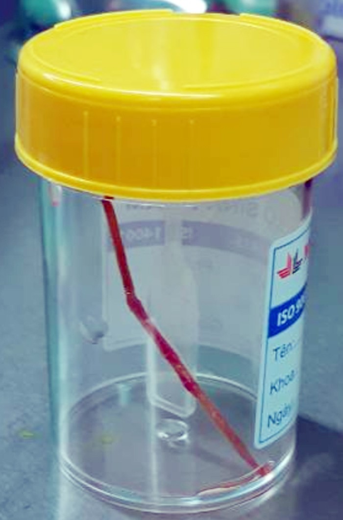 Chiếc tăm tre dài 6cm đâm thủng ruột bệnh nhân ảnh 1