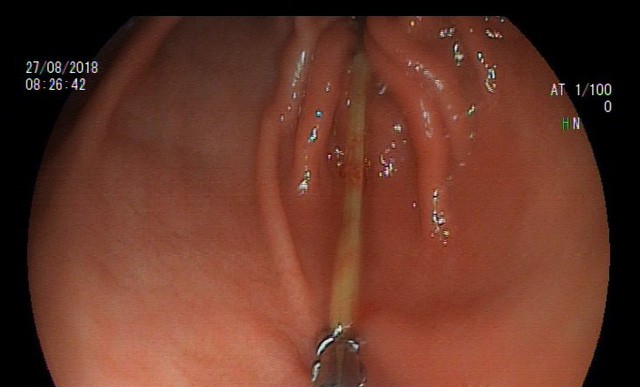 Người đàn ông nuốt cây tăm dài 7cm vì ngủ quên ảnh 1