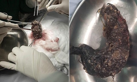 Phẫu thuật lấy búi tóc nặng 1kg trong dạ dày bé gái ảnh 1