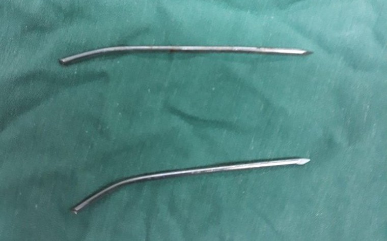 Người đàn ông bị đinh y tế đâm xuyên thực quản, khí quản ảnh 1