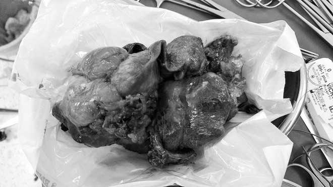 Bé gái mang khối u phổi khổng lồ nặng 1,5 kg ảnh 2