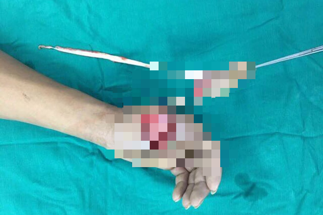 Đứt lìa ngón tay vì bình gas mini phát nổ ảnh 1