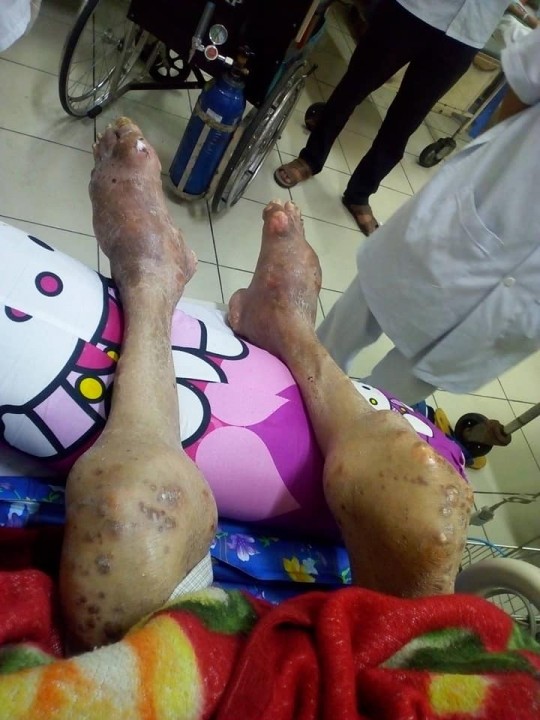 Nghiện rượu lâu năm, tay chân người đàn ông biến dạng khủng khiếp ảnh 1