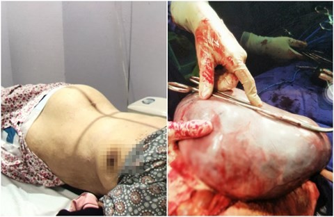 Cụ bà 101 tuổi mang khối u buồng trứng nặng 4kg ảnh 1