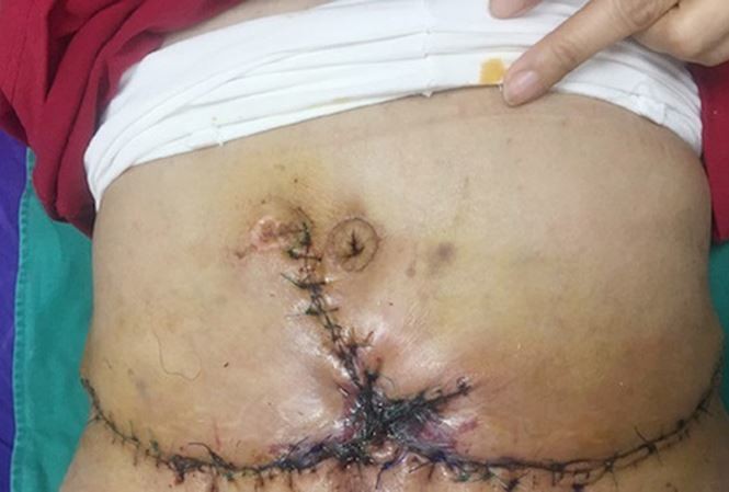 Người phụ nữ bị hoại tử bụng vì hút mỡ giảm béo ảnh 1