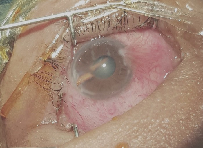 Chặt cây mây, người đàn ông bị gai đâm thủng mắt ảnh 1