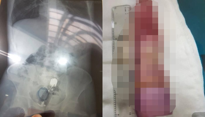 Dương vật giả kẹt sâu trong hậu môn, nam thanh niên nguy kịch ảnh 1