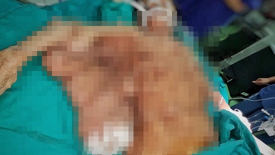 Giải thoát người phụ nữ 40 năm sống chung với hàng trăm khối u ảnh 1