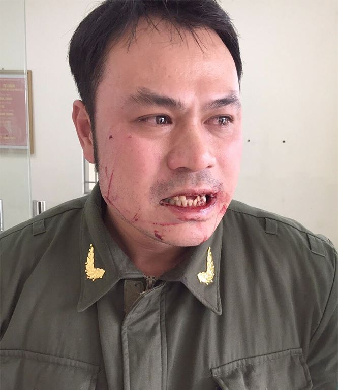 Nhân viên an ninh sân bay Nội Bài bị cò mồi taxi đánh gãy 4 răng ảnh 1