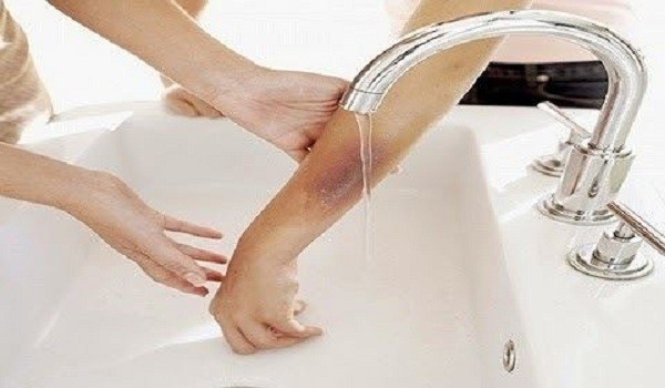 Cụ ông chết thương tâm vì không đi viện mà chữa bỏng ở nhà thày lang ảnh 1