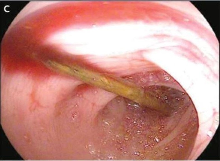 Tăm dài 5cm đâm thủng thành ruột của thanh niên 18 tuổi ảnh 1