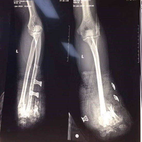 Nam thanh niên bị cụt hai bàn tay vì chế pháo nổ ảnh 1