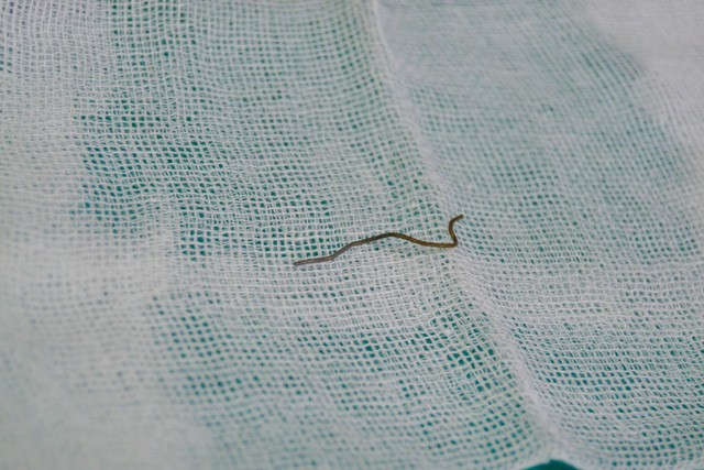 Ăn thịt gà nướng, nam thanh niên nuốt cả dây thép ảnh 1