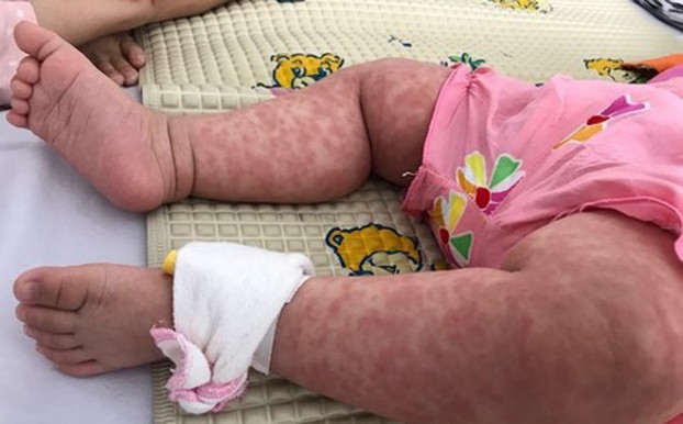 Hà Nội ghi nhận 114 ca mắc sởi trong những ngày đầu năm ảnh 1