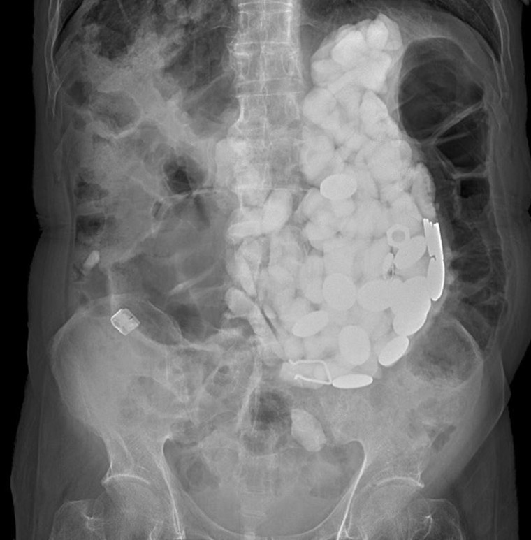 Người đàn ông nuốt 2kg đá, tiền xu và nắp chai vì lí do không ngờ ảnh 1