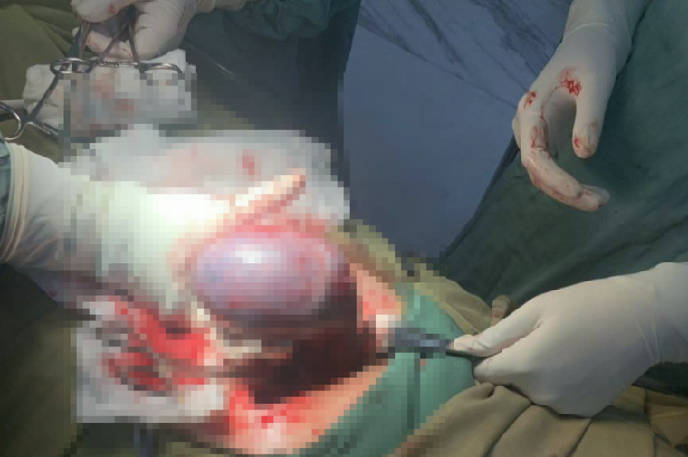 Cứu sống sản phụ mang khối u xoắn đang hoại tử ảnh 1