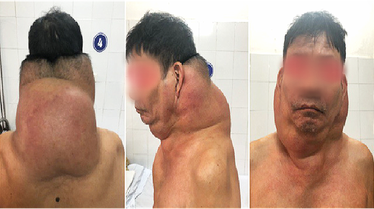 Loại bỏ khối u khủng trên cơ thể người đàn ông ảnh 1