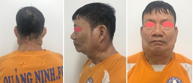 Loại bỏ khối u khủng trên cơ thể người đàn ông ảnh 2