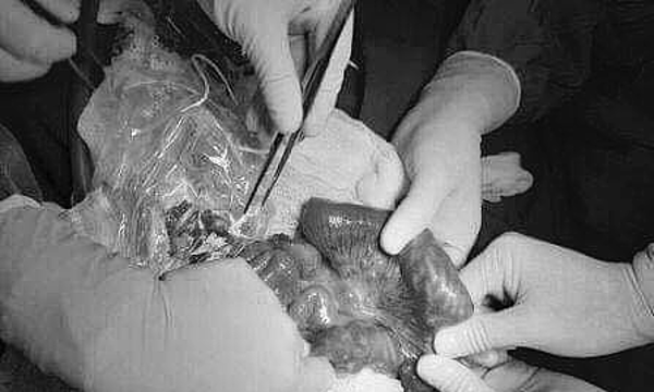 Bé trai 3 tuổi bị búi giun lớn làm tắc ruột ảnh 1