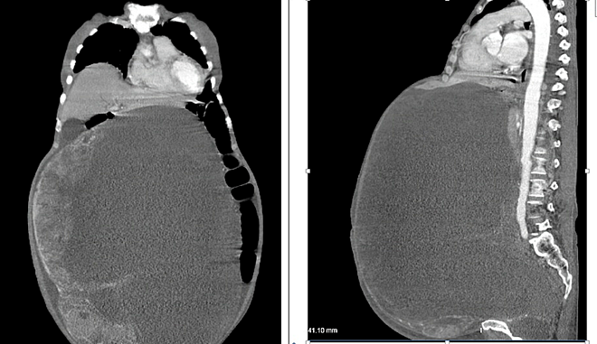Bà cụ 78 tuổi mang khối u buồng trứng nặng 30kg ảnh 1