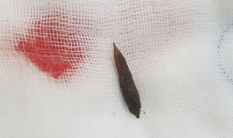 Người phụ nữ thủng ruột vì nuốt phải hạt chà là ảnh 1