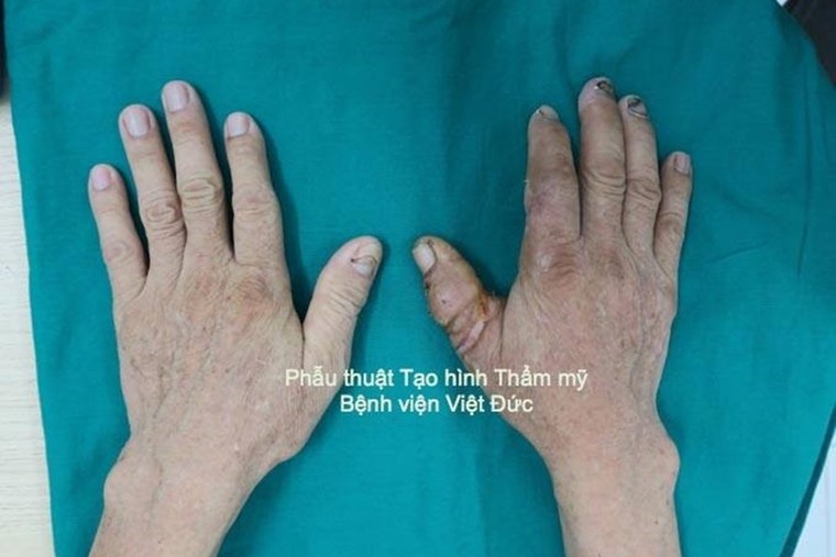 Phẫu thuật nối ngón tay cái đứt rời cho người đàn ông ảnh 1