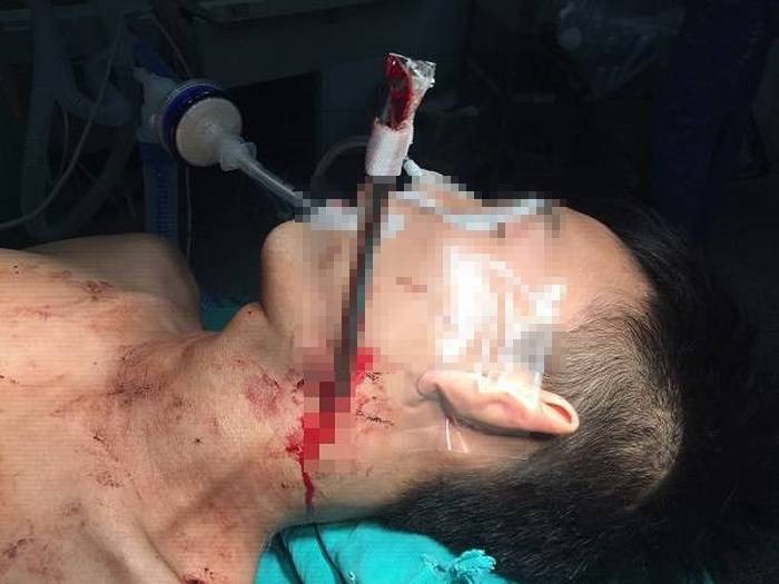 Cứu nam thanh niên bị thanh sắt đâm thấu cổ ảnh 1