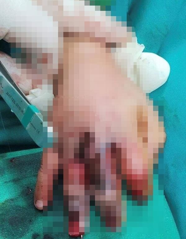 Bé trai 4 tuổi bị máy nước mía cuốn dập bàn tay ảnh 1