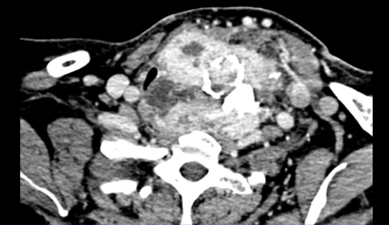 Cắt khối u bướu cổ khổng lồ cho người phụ nữ ảnh 1