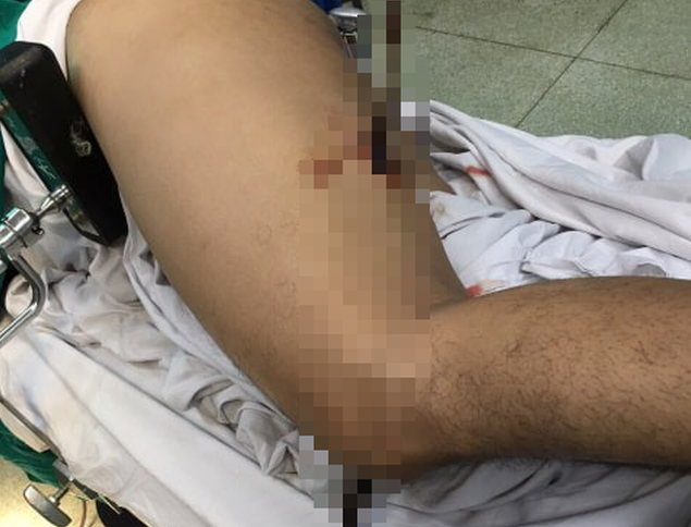 Ngã từ trên cao xuống, nam công nhân bị thanh sắt đâm xuyên đùi ảnh 1