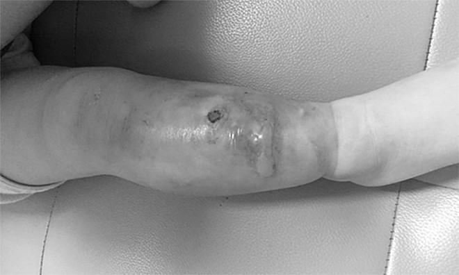 Bé trai nhập viện cấp cứu vì một nốt mụn nhỏ ở cẳng chân ảnh 1