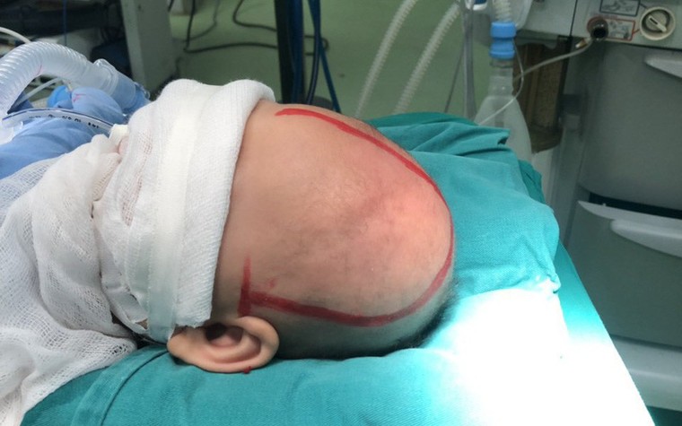 Phẫu thuật dị dạng hộp sọ cho bé 5 tháng tuổi ảnh 1