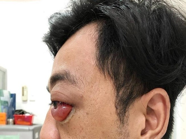 Lồi mắt sau 2 năm bị tai nạn giao thông, thanh niên suýt bị mù ảnh 1