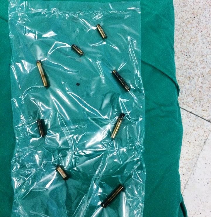 Bé trai 4 tuổi thủng ruột do nuốt 8 thanh nam châm ảnh 1