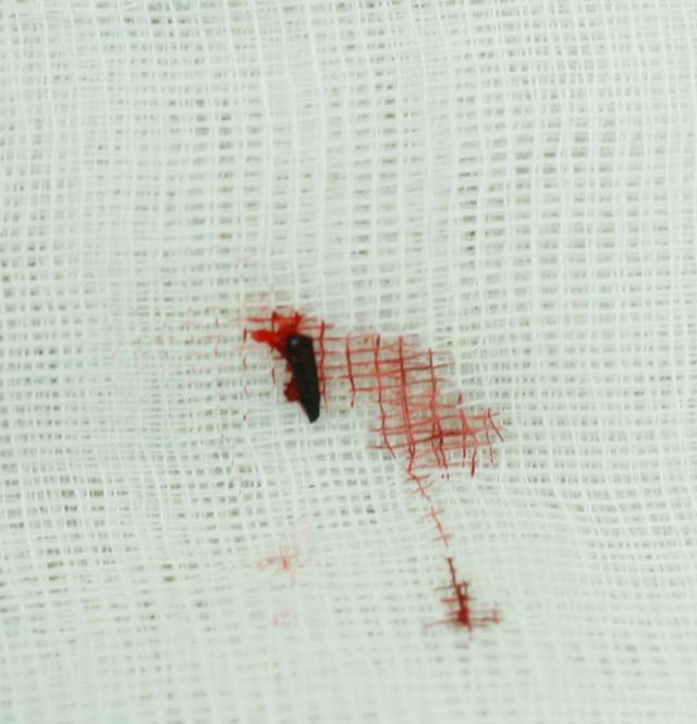 Đầu bút chì nằm trong hốc mắt bé trai suốt 5 năm ảnh 1