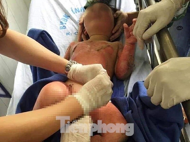 Tình tiết mới vụ 3 cháu bé mầm non bị bỏng khi học kỹ năng ảnh 2