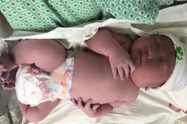 Bé trai mới sinh đã có cân nặng ngang trẻ 3 tháng ảnh 1