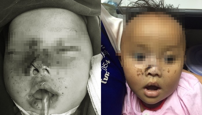 Cứu bé 9 tháng tuổi bị anh trai bắn 10 viên đạn chì vào giữa mặt ảnh 1