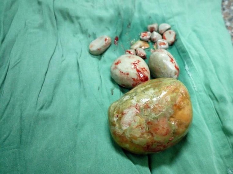 Phẫu thuật lấy viên sỏi khổng lồ cho cụ bà 84 tuổi ảnh 1