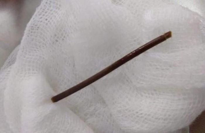 Vô tình nuốt tăm xỉa răng, cụ bà bị thủng dạ dày ảnh 1