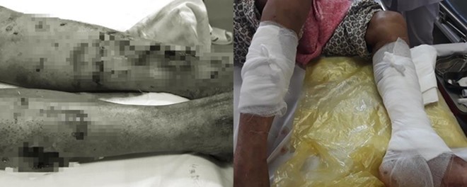 Cụ ông 93 tuổi bị chó nhà nuôi cắn nát 2 chân ảnh 1