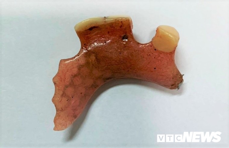 Cung răng dài 30mm án ngữ trong thực quản người phụ nữ ở Quảng Nam ảnh 1