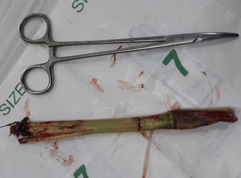 Bé trai 8 tuổi bị gốc cỏ đâm thủng bụng khi chơi đùa ảnh 1