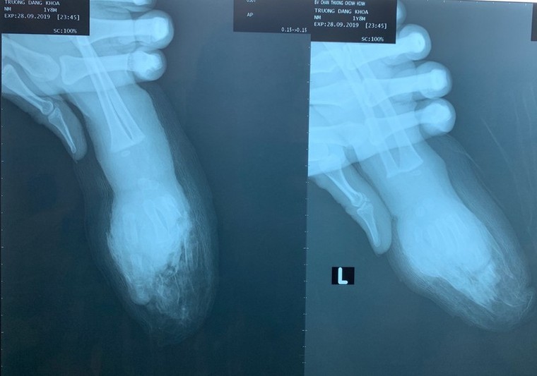 Người lớn lơ là, bé trai bị đứt lìa 4 ngón tay ảnh 1