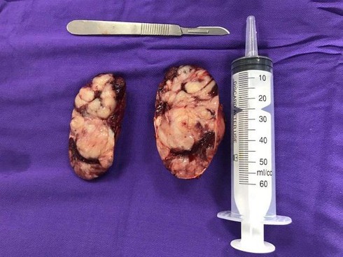 Mắc bệnh hiếm gặp, bé 19 tháng tuổi 'thoát chết' thần kỳ ảnh 2