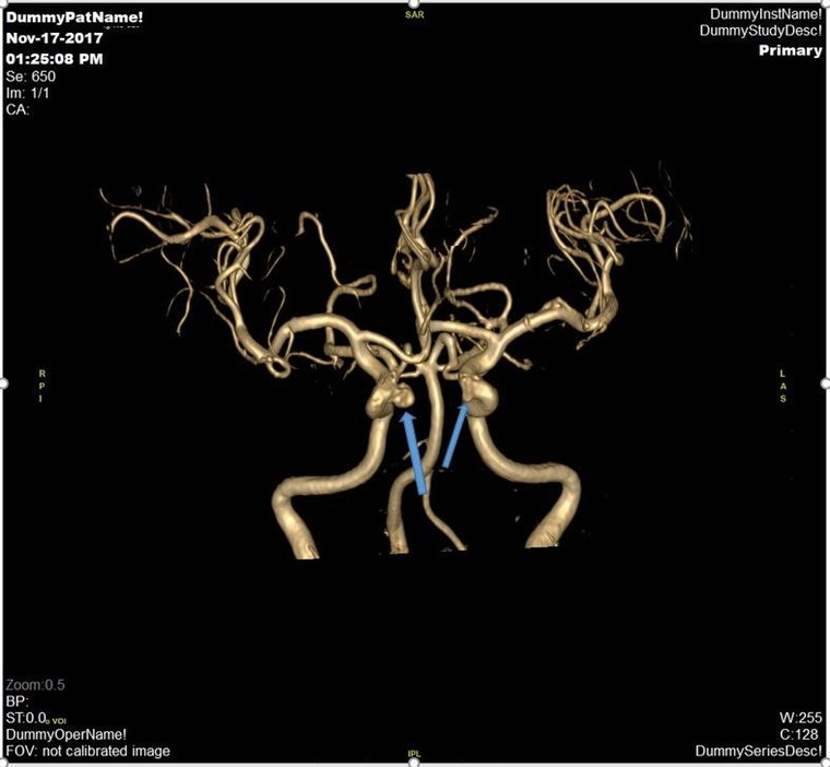 Đột quỵ não và vai trò của chụp cộng hưởng từ (MRI) trong tầm soát đột quỵ ảnh 2