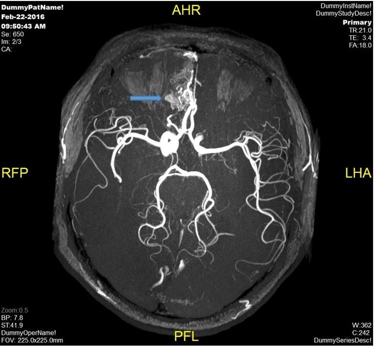 Đột quỵ não và vai trò của chụp cộng hưởng từ (MRI) trong tầm soát đột quỵ ảnh 3