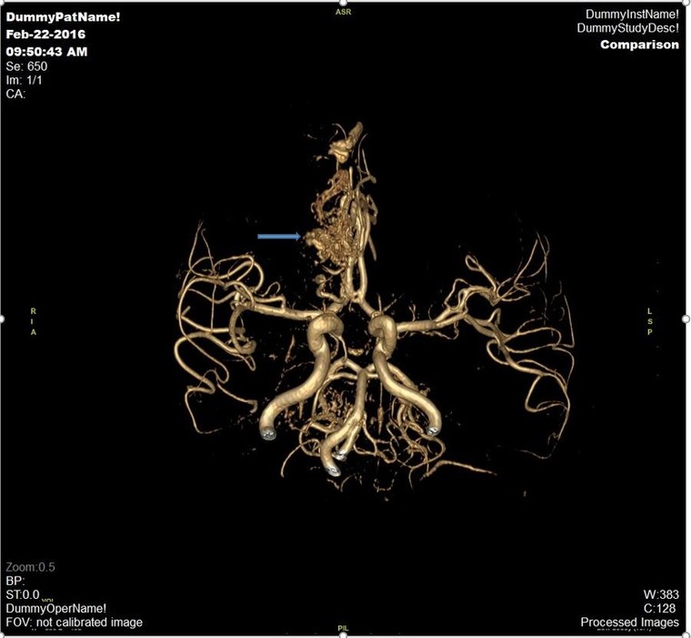 Đột quỵ não và vai trò của chụp cộng hưởng từ (MRI) trong tầm soát đột quỵ ảnh 4