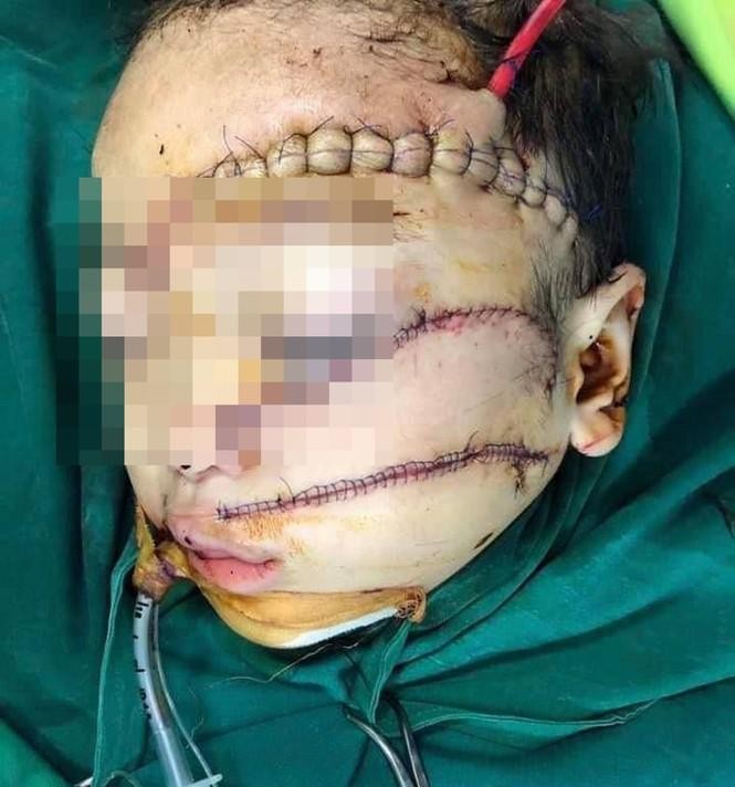 Bật ‘báo động đỏ’ cứu cháu bé 5 tuổi bị cha chém nát mặt ảnh 1