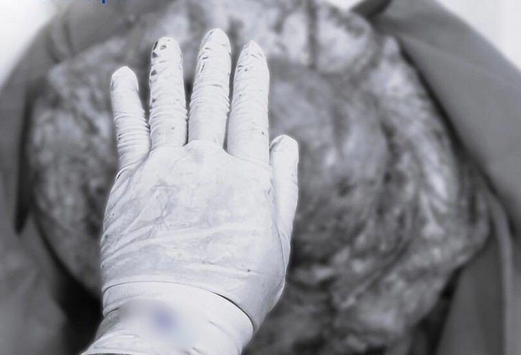 Người phụ nữ có khối u nang thận nặng gần 6kg chỉ sau một năm uống thuốc nam ảnh 1